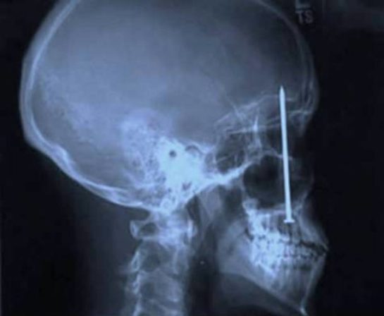 25 Strange Things Found In an X-Ray - Reader's Cave